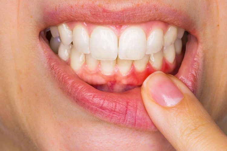 Diş Eti Hastalıkları Uzmanı Diş Eti Hastalıkları Tedavisi Cerrahisi