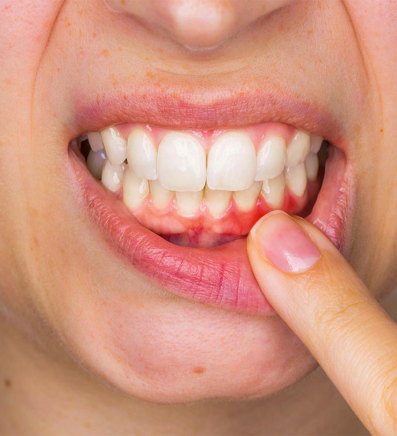 Diş Eti Hastalıkları Uzmanı Diş Eti Hastalıkları Tedavisi Cerrahisi