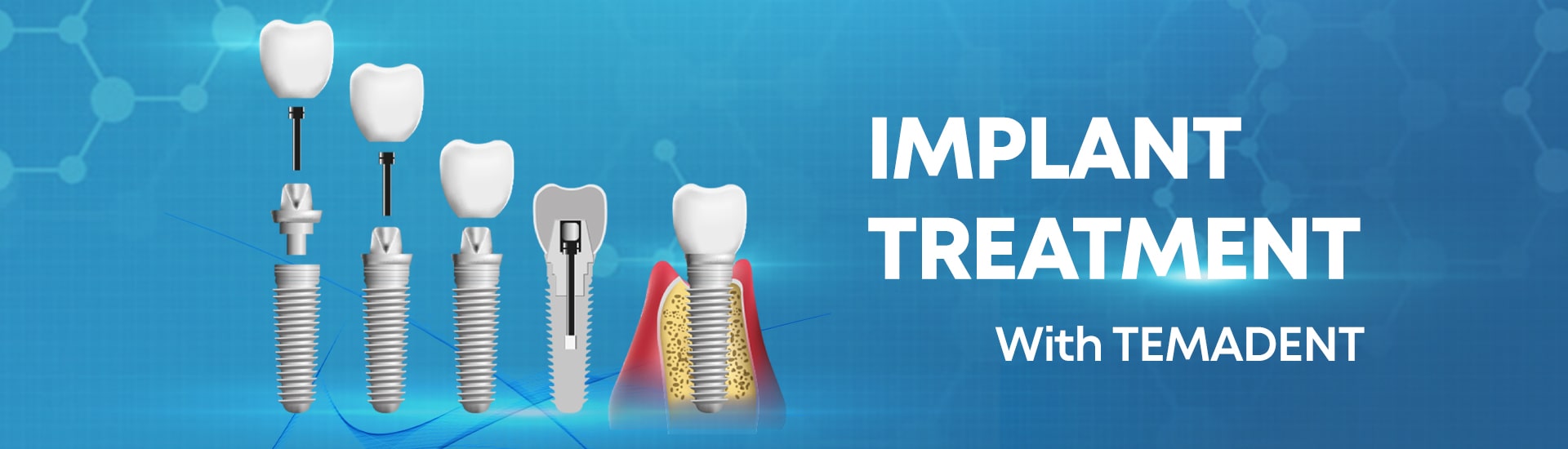 implant-treatment-banner
